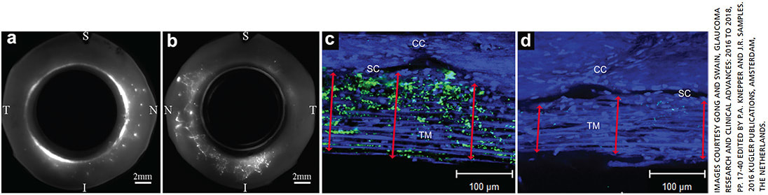 Figure 1. Segmental aqueous flow pattern in normal human eyes. a: A global image showing segmental tracer distribution in the trabecular meshwork (TM). b: Segmental tracer distribution in the scleral veins. c: In the active outflow area (demonstrated by green fluorescent tracers), the TM is more expanded with more open spaces. d: In inactive flow areas (little to no green fluorescent tracers), the TM is more compacted (compare the red double arrows in c and d). Note both the active and inactive flow areas are near a collector channel (CC).