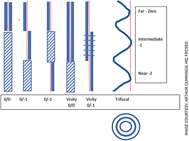 FIGURE 1. Sketch illustrating the value proposition of monofocal IOLs (three on the left with different refractive targets on the reading eye), the Vivity (Alcon) IOL at 0/0 and 0/-1 and a trifocal IOL. The thick blue lines represent where you can see without glasses, while glasses are required for the shaded area with diagonal lines.