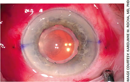 Figure 3A. Well-centered IOL following McCabe double belt loop surgery for dislocated IOL secondary to pseudoexfoliation syndrome. Note the buried Prolene sutures 180 degrees apart, just posterior to the limbus.