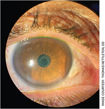 Slit lamp photo of a recently FDA-approved IOL technology we have incorporated in our practice: AcuFocus’ IC-8 Apthera IOL.