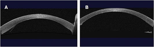 Anterior segment OCT of a patient status post-DMEK. A. Post-op week 1. B. Post-op month 1.