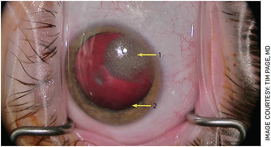 FIGURE 4. A monocular patient with a zonular dialysis (Arrow 1) and silicone oil (Arrow 2) in the eye. The stakes are high to keep the silicone oil in the eye or risk another retinal detachment. Preoperative plan is to keep the anterior chamber pressure high at all times with a dispersive ophthalmic viscosurgical device. A capsular tension ring will be required to stabilize the capsular bag.