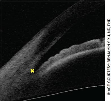 FIGURE 1. Anterior segment OCT image with location of the scleral spur marked (yellow X).