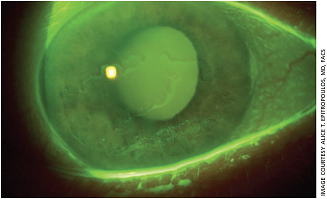 Figure 2. A 58-year-old male patient had 2+ nuclear and cortical cataracts, as well as significant epithelial basement membrane dystrophy.