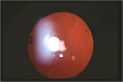 Figure 1. Striae in the posterior capsule causing a Maddox rod effect. A patient reported single streak 90 degrees away from the striae. This is easily treated with Nd: YAG capsulotomy.