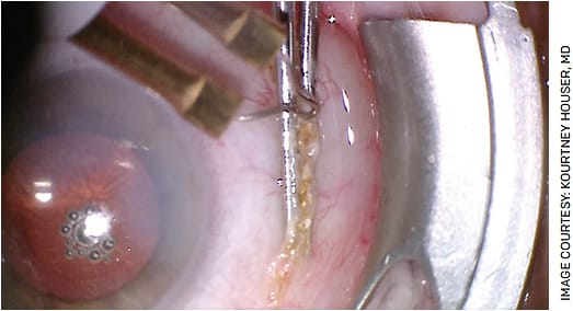 FIGURE 3. Handheld high temperature cautery applied in a linear fashion to inferior bulbar conjunctiva gathered with angled tying forceps