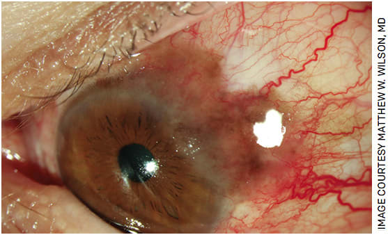 FIGURE 1. Slit lamp examination revealed a conjunctival melanocytic lesion extending onto the cornea.