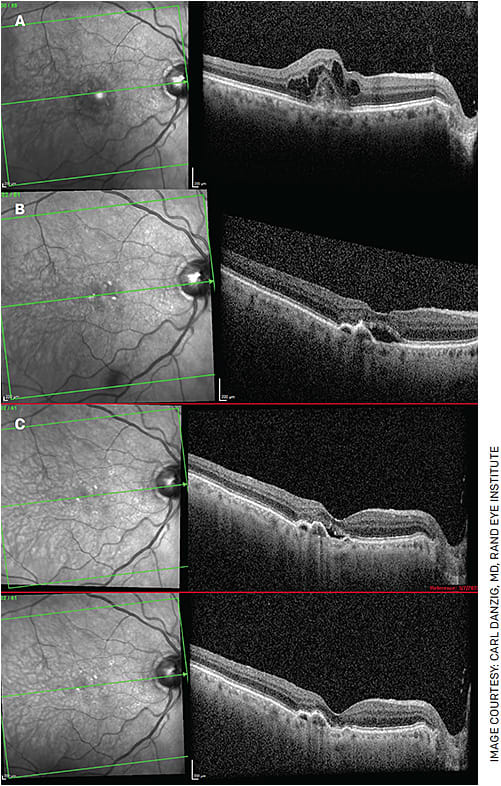 FIGURE 2. A 94-year-old gentleman has been receiving injections monthly since 2013. Figure 2A shows choroidal neovascularization with CME. This patient is highly compliant, averaging 11-12 injections per year, and was able to maintain 20/30 vision for many years. Even with a trial of Q2W injections, his subretinal fluid never resolved. Despite his frequent injections over the years, his vision declined somewhat to 20/60.
