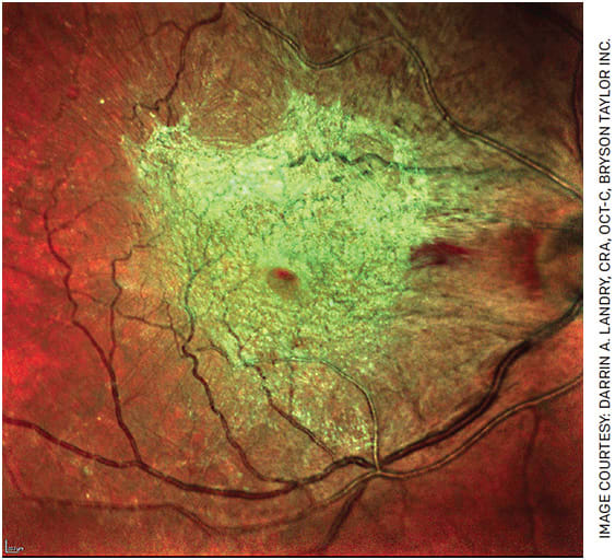 Multicolor fundus image of a visually significant epiretinal membrane with marked fibrosis.