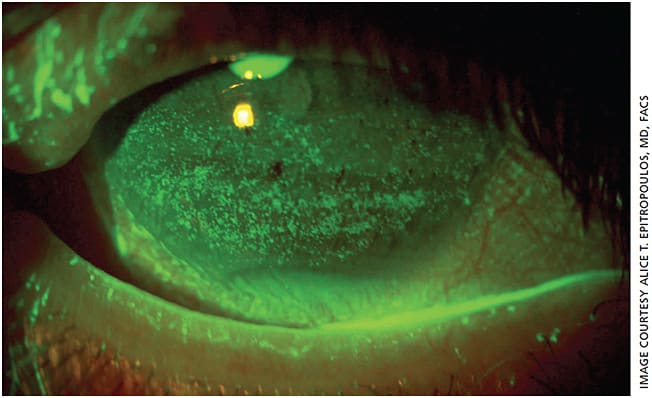 Figure 1. Both eyes of this 67-year-old female patient had significant punctate epithelial keratopathy.