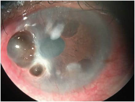 Figure 3. Stage 3 NK. Advanced case of recurrent herpes simplex keratitis, ultimately leading to perforation from severe reactivation of the virus following shingles on the thorax.