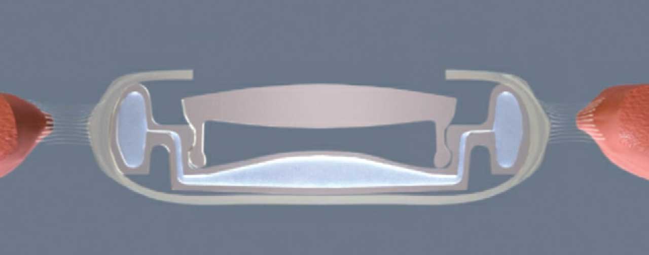 Schematic drawing showing the Atia Vision OmniVu accommodating IOL in the accommodated state