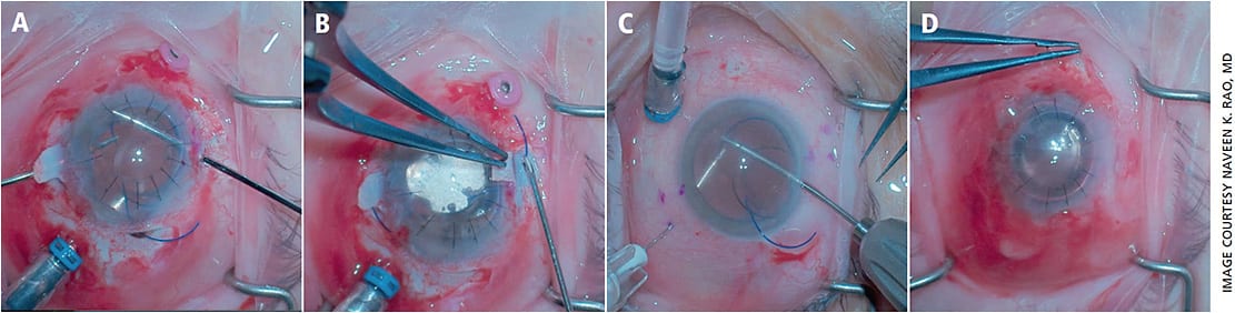 Figure 1. Glued IOL intrascleral haptic fixation. A. The leading haptic is grasped using the “handshake technique” and externalized. B. A Scharioth pocket is created in the sclera, parallel to the limbus. C. Fibrin glue is applied under the scleral flaps and to close the conjunctival peritomies. D. The IOL is centered well upon the conclusion of surgery.