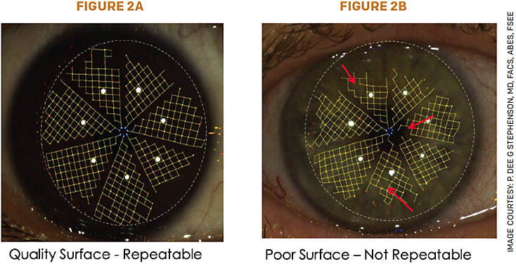 FIGURE 2. Cassini surface qualifier honeycomb patterns using a Cassini topographer. When the pattern looks like a honeycomb (2A) and is not missing any sides to the pattern (such as where the arrows are pointing in 2B), then it is a repeatable pattern. The surface of the cornea is then in great shape to proceed with surgery.