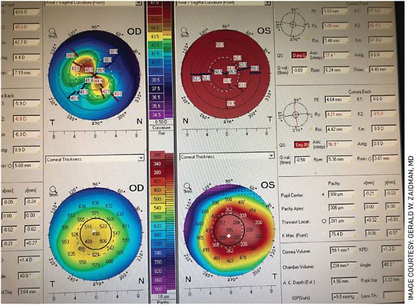 Topography of a child with bilateral keratoconus that is very severe in one eye