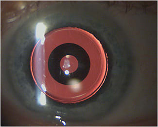 Figure 3. Small-aperture IOL (IC-8, AcuFocus) after laser cataract surgery