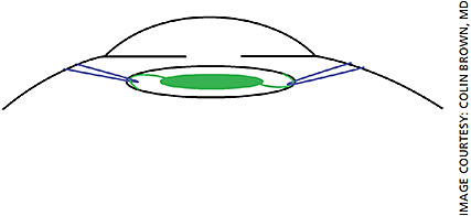 Figure 3B. Internal schematic of double belt loop surgical technique. Prolene suture (blue) is “looped” around the haptics (green) and IOL complex 180 degrees apart, providing two-point fixation.