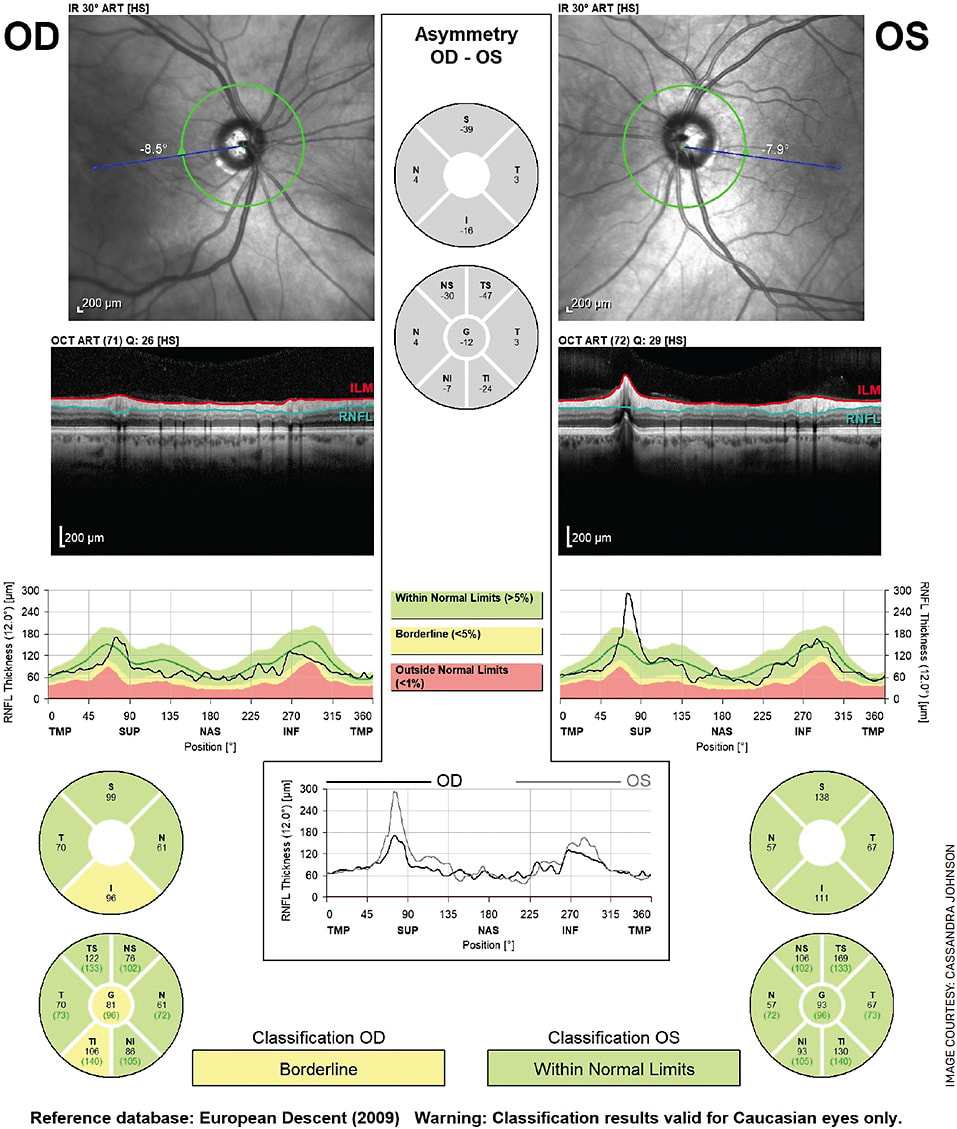 FIGURE 2. Heidelberg Spectralis RNFL and ONH OU demonstrating inferotemporal
thinning of nerve fiber layer OD.