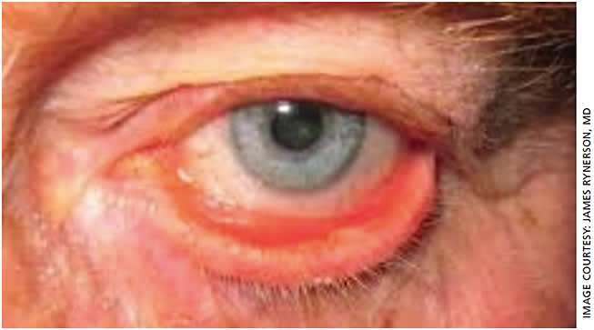 Figure 2. Stage 4 blepharitis with ectropion.