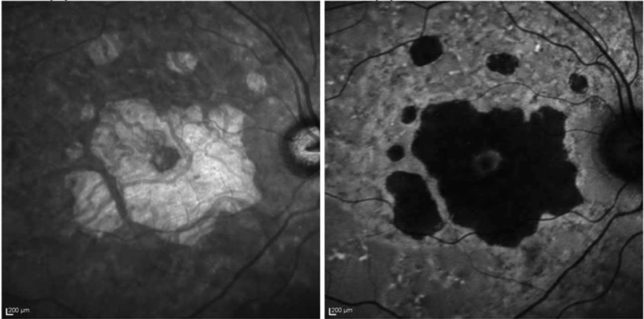 Figure 5. Geographic atrophy appears light with infrared (left) and dark with FAF (right). Images via Heidelberg Spectralis.