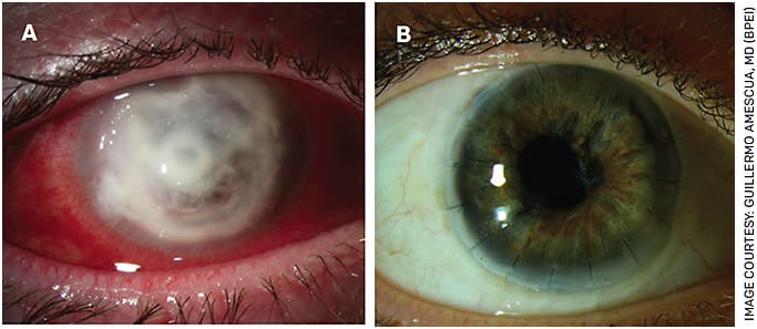 FIGURE 5. Slit lamp photograph of severe, refractory Acanthamoeba keratitis with a perforated cornea (A). This eye underwent a therapeutic penetrating keratoplasty. At last follow up (5 years after surgery), her visual acuity remains 20/25 (B).