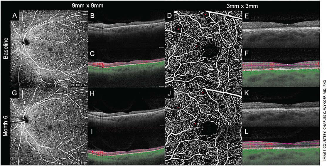 Figure 3. Optical coherence tomography angiography (OCTA) from the ongoing prospective PRIME trial at baseline (A through F) and month 6 (G through L). 9mm x 9mm (A and G) and 3mm x 3mm (D and J) angiogram analysis demonstrating detailed blood flow through the superficial retina. B-scan at the fovea (B, E, H and K). B-scan at the fovea with color-coded blood flow (C, F, I and L): (red: retinal blood flow, green: choroidal blood flow) and corresponding angiography segmentation (pink dotted lines). Red asterisks indicate areas of retinal nonperfusion. The diabetic retinopathy severity scale (DRSS) for this eye improved from 53 at baseline to 43 at month 6 with five intravitreal aflibercept injections. Concurrent with improvement in DRSS level, while there was no widespread change in extent of retinal non-perfusion, focal areas were visualized that demonstrated subtle improvements in vascular visibility (for example, superior asterisk baseline compared to month 6). Images captured on the Zeiss PLEX Elite 9000.