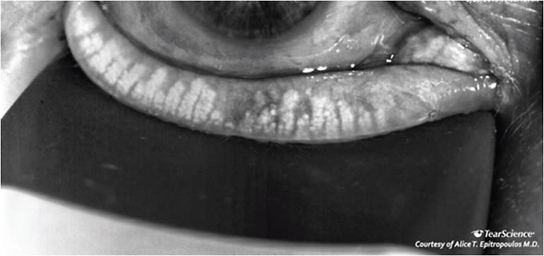 Figure 5. Meibomian imaging, using LipiView (Johnson &amp; Johnson Vision), showed significant atrophy of the patient’s meibomian glands.