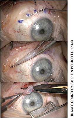 FIGURE 2. The Paste-Pinch-Cut conjunctivoplasty method in three steps, top to bottom