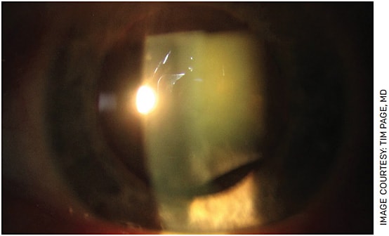 FIGURE 1. This traumatic cataract with zonular dialysis may require a vitrectomy, vitreous stain, capsular tension ring with or without scleral or a capsular tension segment with scleral fixation.