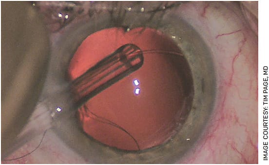 FIGURE 3. Using a 10-0 nylon suture in the leading eyelet of a capsular tension ring provides a visible tracer for the position of the leading eyelet. Any pause in the forward movement of the suture during deployment will alert the surgeon to a possible entanglement or entrapment. It will also serve as a safety retrieval mechanism in the event it is dislodged into the vitreous or inadvertently placed in the sulcus.