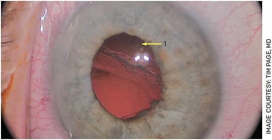 FIGURE 5. In eyes with a large zonular dialysis (Arrow 1), it helps to have a standard kit prepared for these complex cases.