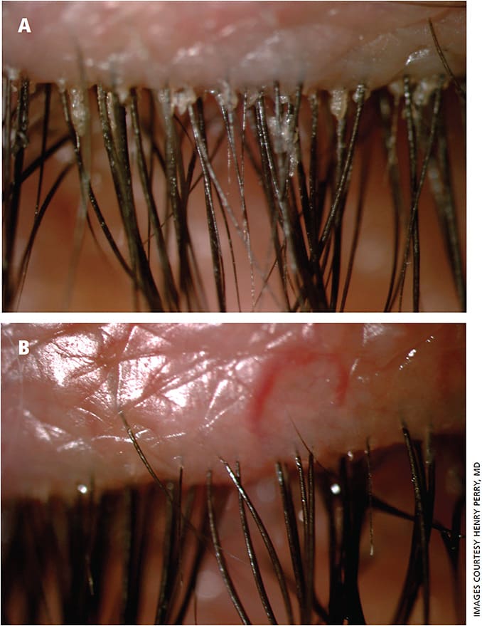 Figure 3. A. Demodex blepharitis before four-minute microblepharoexfoliation. B. Demodex blepharitis immediately after treatment.