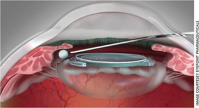 Figure 3. Dexycu is injected as a depot intracamerally behind the iris following IOL insertion and viscoelastic removal.