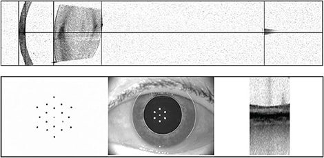 Figure. Patient images from the Zeiss IOLMaster 700. Bottom right: 1-mm macular OCT image. Bottom left: Keratometry image. Note irregularity of spots in this patient with ocular surface disease. These improved upon treatment, and the patient was retested prior to IOL type/power determination.