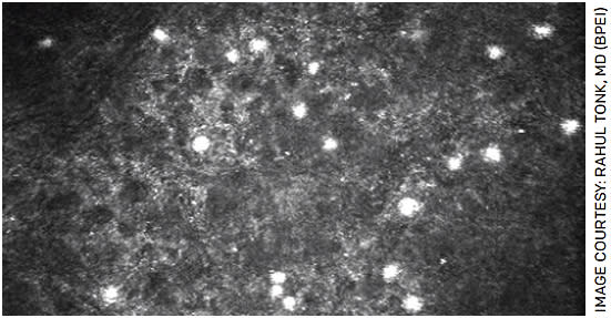 FIGURE 3. In vivo confocal microscopy showing clusters of Acanthamoeba cysts in the corneal epithelium