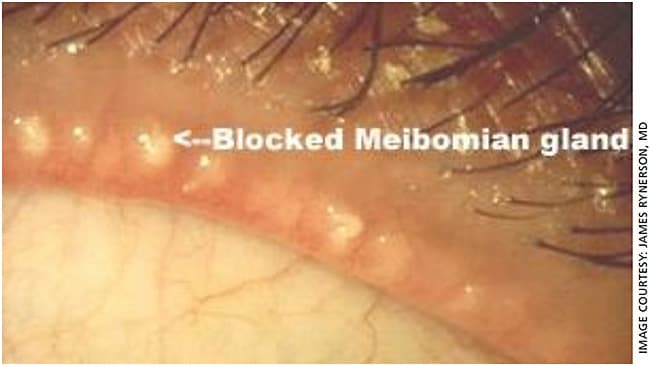 Figure 1. Stage 2 blepharitis with blocked meibomian glands.