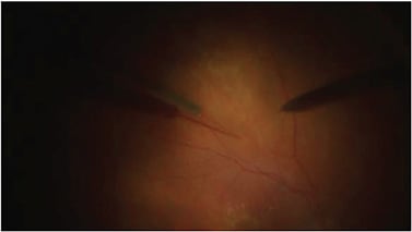 FIGURE 2. Surgical procedure to administer sub-retinal gene therapy