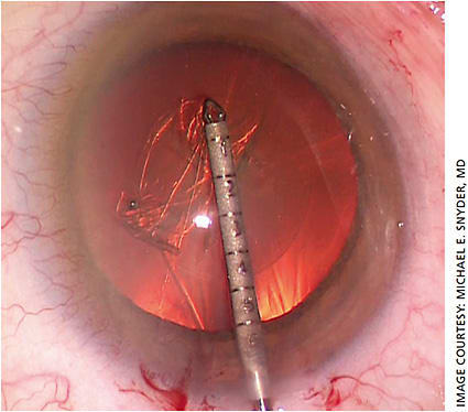 A high efficiency, reproducibly safe, low-cost, reusable capsulorhexis machine with no “click fee” (Seibel forceps, MST).