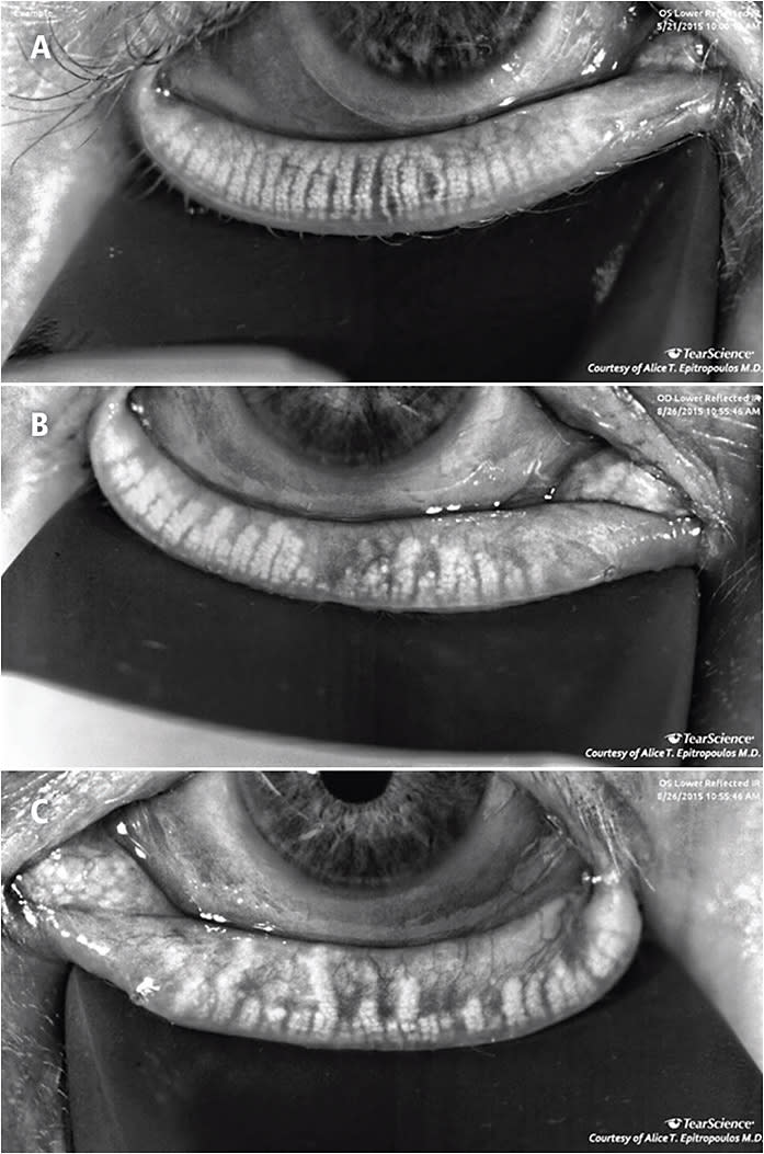 Figure. Meibography images of patients with mild (A), moderate (B) and severe (C) meibomian gland atrophy being evaluated for DED prior to cataract or refractive surgery.