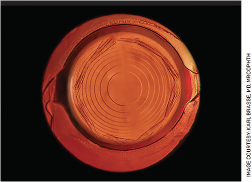 FIGURE 2. Capsule opening from Tango Reflex Neo YAG/SLT laser