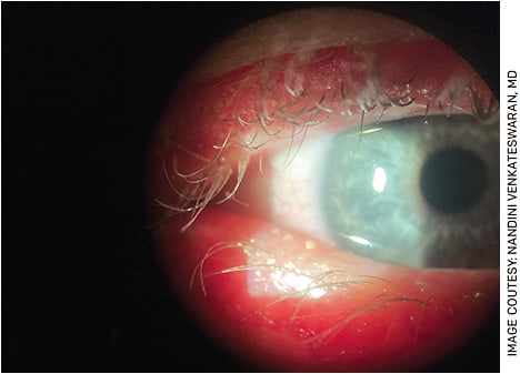 FIGURE 2. Capped meibomian glands seen along the right lower eyelid clinically suggestive of significant meibomian gland dysfunction. This patient underwent thermal pulsation therapy in the office.