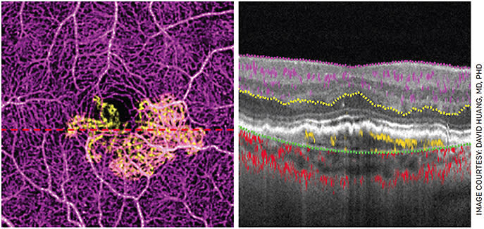 OCT angiography (OCTA) can detect choroidal neovascularization (CNV) before exudation occurs. The 3x3-mm en face OCTA image (left) shows CNV (yellow) in relation to the retinal circulation (purple) in an eye with AMD. The cross-sectional OCTA (right), taken at the dotted line on the en face image, shows the CNV (yellow) to be under the pigment epithelium and not associated with any retinal fluid accumulation. The CNV was not visible on fluorescein angiography (no visible leakage).