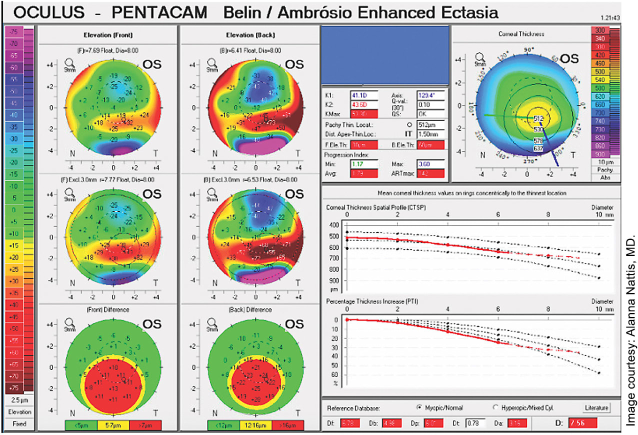 FIGURE 3. Image of corneal topography/tomography illustrating keratoconus staging printout that is provided via the Pentacam. This is very helpful as a global picture of keratoconus and helpful information for following progression of disease as well as post-crosslinking.
