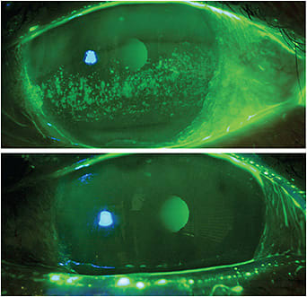 Figure 1. Amniotic membranes aid in corneal re-epithelialization and provide apoptosis of pro-inflammatory cells in persistent keratitis.Figure 1 courtesy of Dr. Kataria.