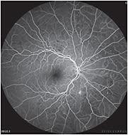 IMAGE: This image from the Clarus 700 shows diabetic retinopathy OD, via widefield fluorescein angiography. OM