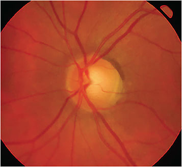 Clinical photo of the high-risk glaucoma suspect, who was also 10 weeks pregnant. Image courtesy of Dr. Austin Lifferth.