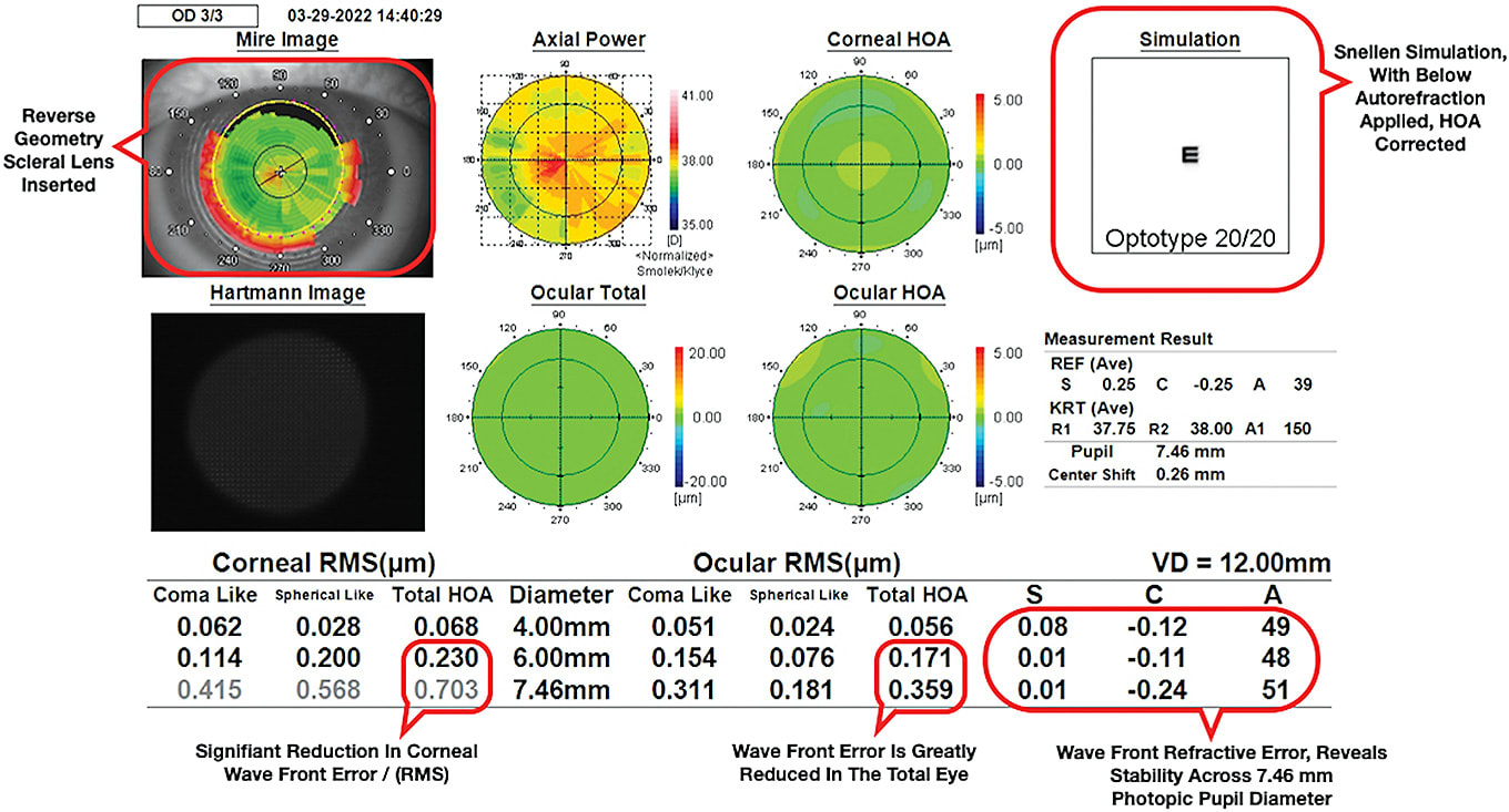 Figure 2. Aberrometry reading of same patient after fitting with scleral lens; patient has excellent night vision, no eye strain in all lighting conditions, and the patient’s ghosting of text on signs has been eliminated. Image courtesy of Dr. Brandon.