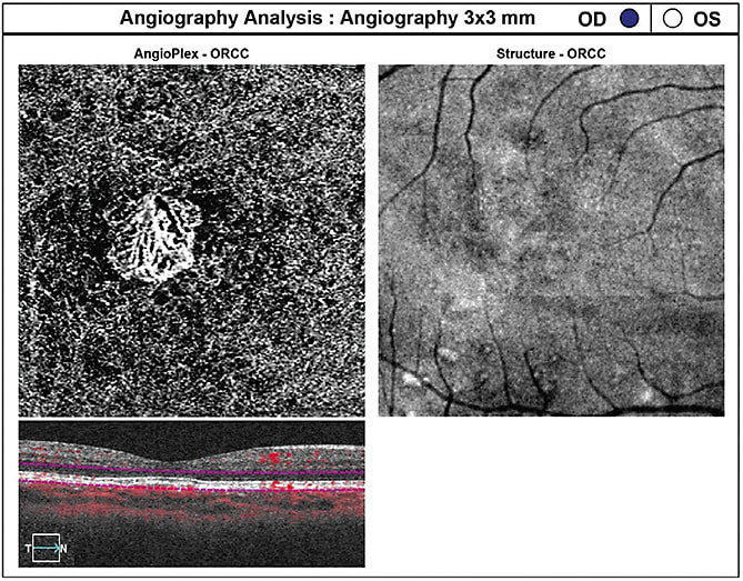 Figure 1. 3 x 3 mm OCTA of the macula OD, outer retina-choriocapillaris (ORCC) enface display. Angiography reveals a well-defined type 1 (sub-RPE) CNV. Image courtesy of Dr. Carolyn Majcher