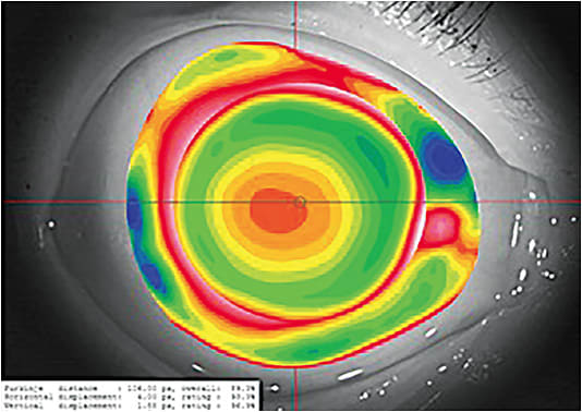 Corneal topographers project a series of concentric rings or colored dots on the cornea. Note this image of corneo-scleral topography. 
Image courtesy of Keimberly Grizzaffi