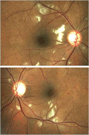 Figure 2. A 31-year-old Black female, with a known history of systemic lupus erythematosus (SLE) and no other systemic or secondary renal complication, presented with signs of retinal vaso-occlusive disease evident by cotton wool spots, occluded retina vessels, and retinal hemorrhages in both eyes.